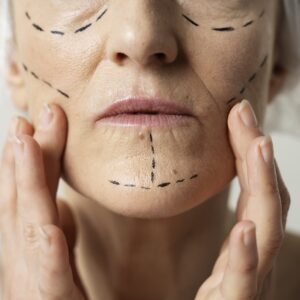 Toxina Botulínica – Líneas de Expresión (Tercio Superior)